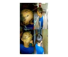 Losion protiv alopecije